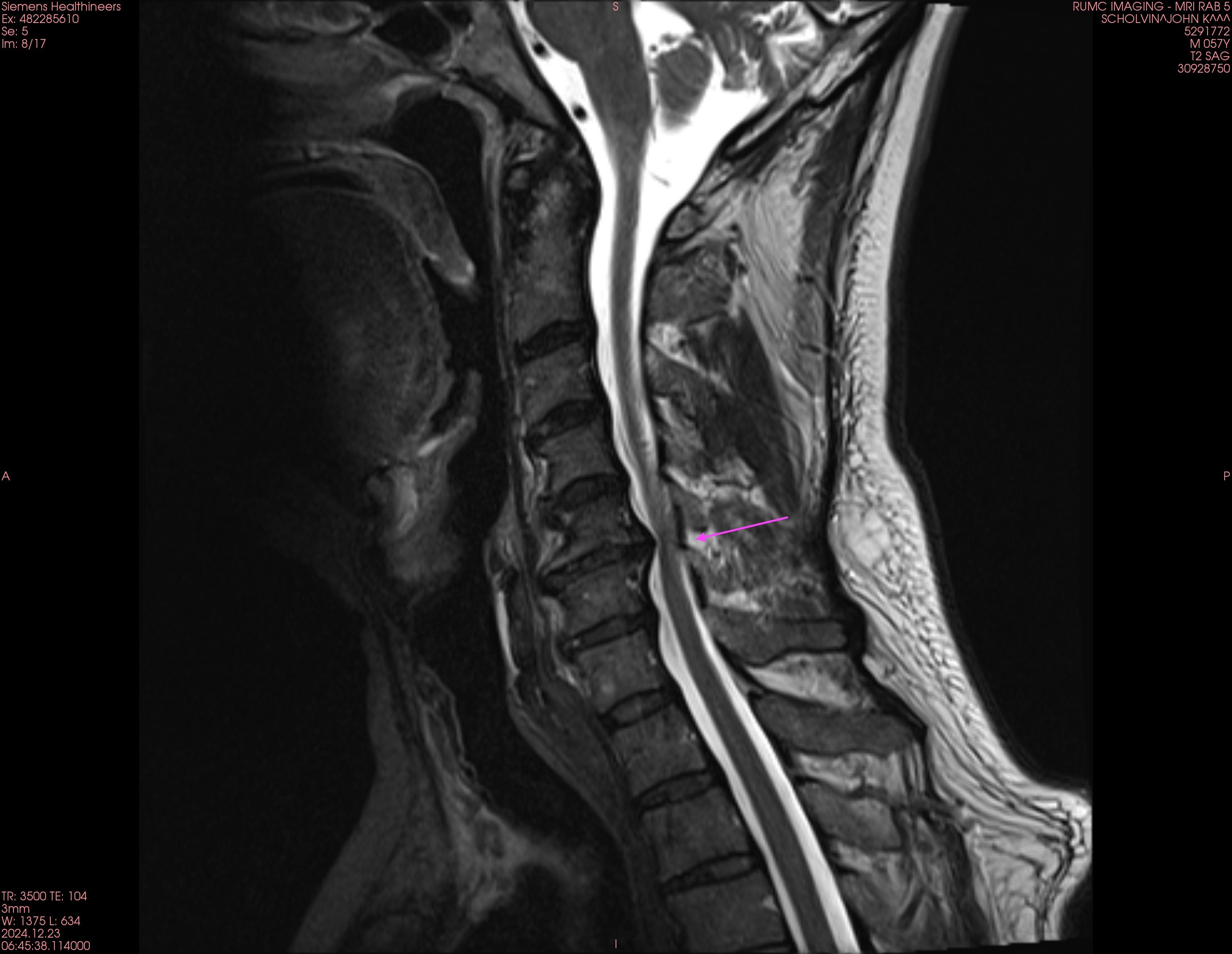 an MRI of my neck showing discs compressing the spinal cord