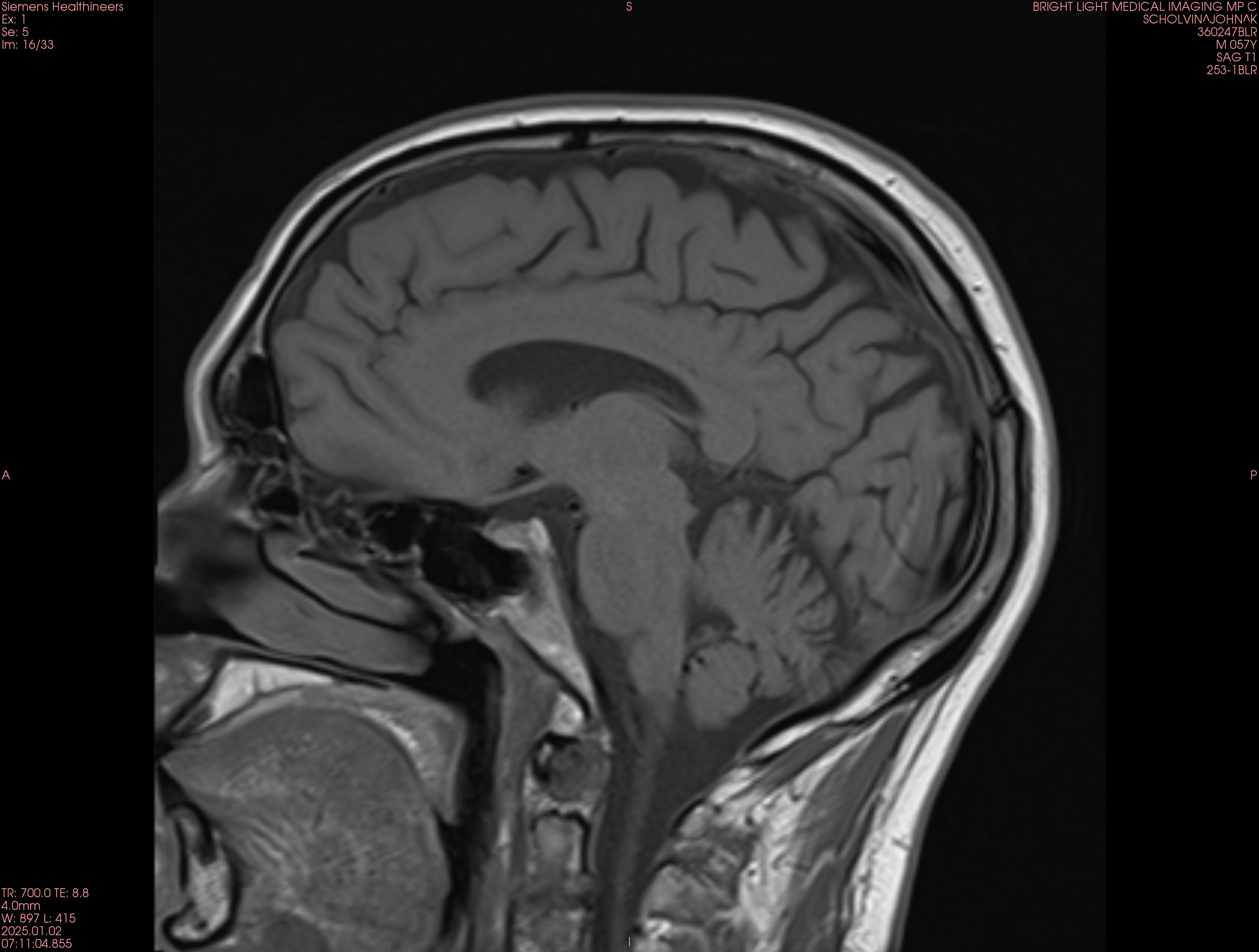 an MRI of my brain