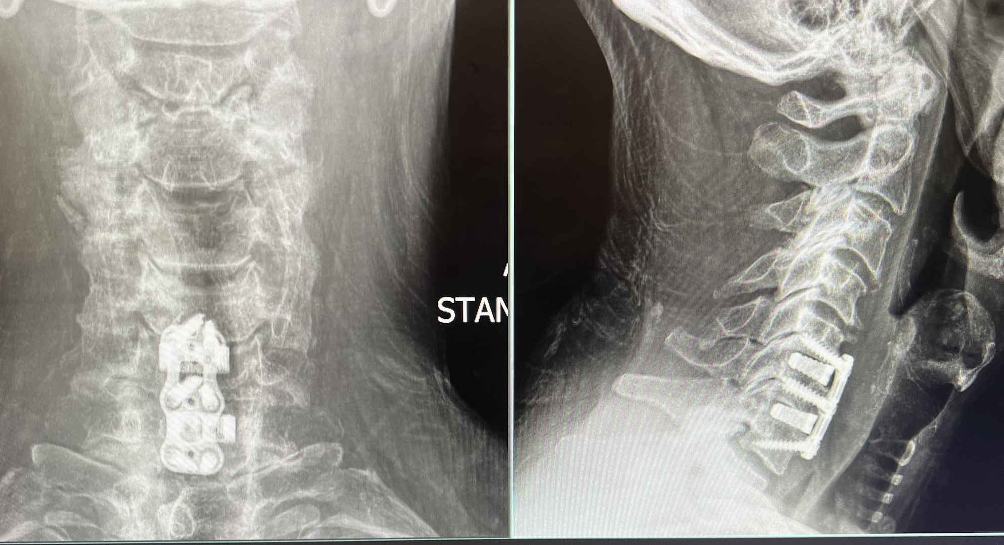 an X-ray of my neck, showing the new titanium parts